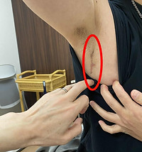 MICS - 低侵襲心臓手術【低侵襲治療スペシャルサイト】心臓血管研究所